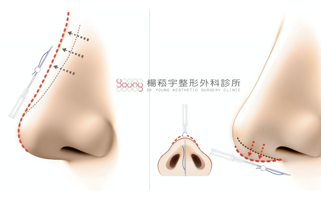 隆鼻手術